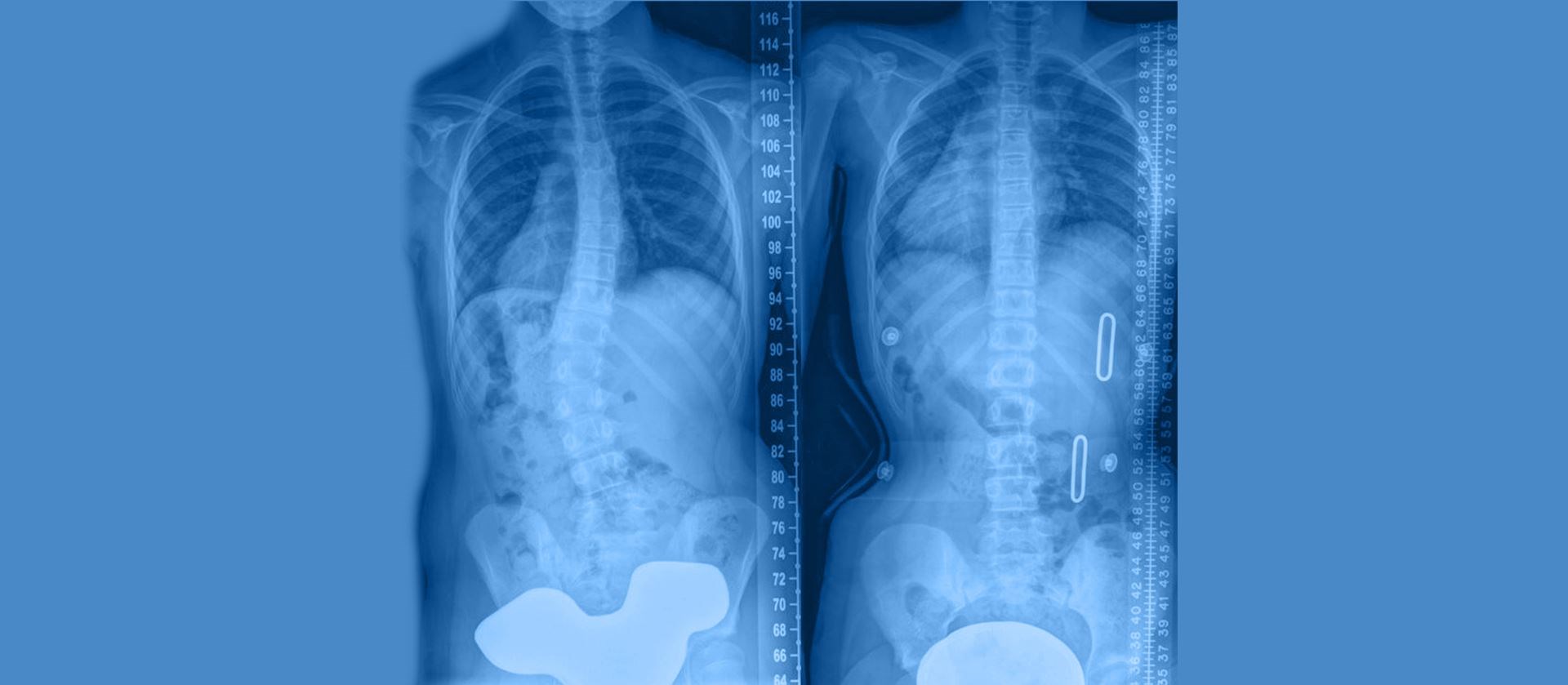 Maximize 3 dimensional in-brace correction and balance